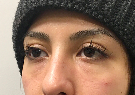 PRP For Tear Troughs Case #3