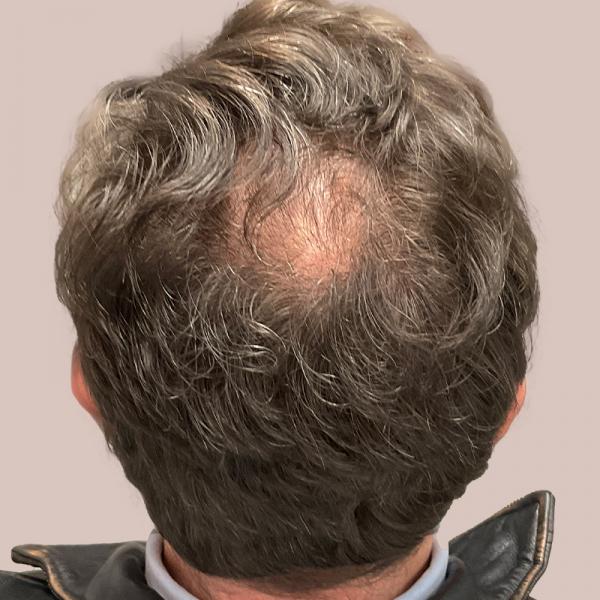 PRP Hair Restoration Case #1