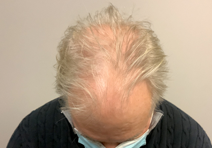 PRP Hair Restoration Case #4