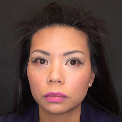 PRP Hair Cover Image