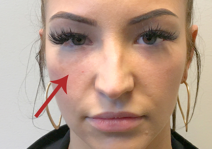 PRP For Tear Troughs #6